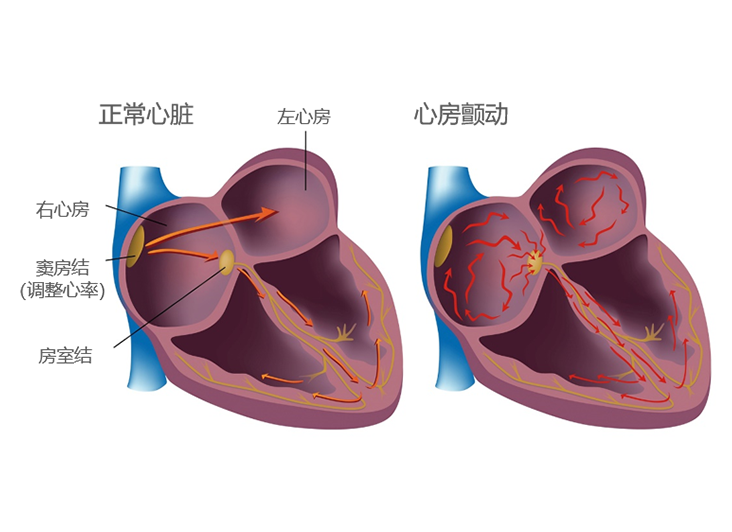 心动过速